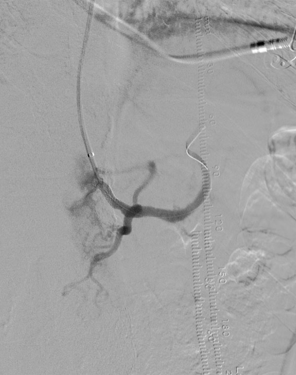 HIGH CELIAC 2: Celiac artery stent