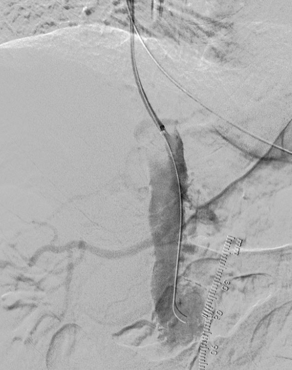 HIGH SMA 1: Superior mesenteric artery stenosis