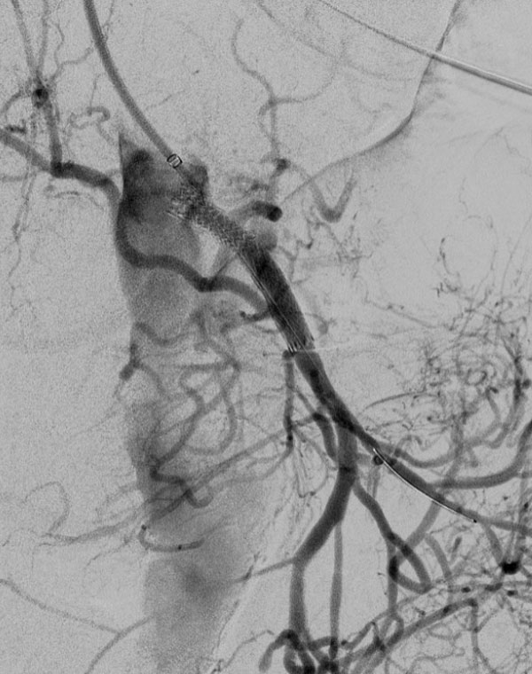 HIGH SMA 2: Superior mesenteric artery stent