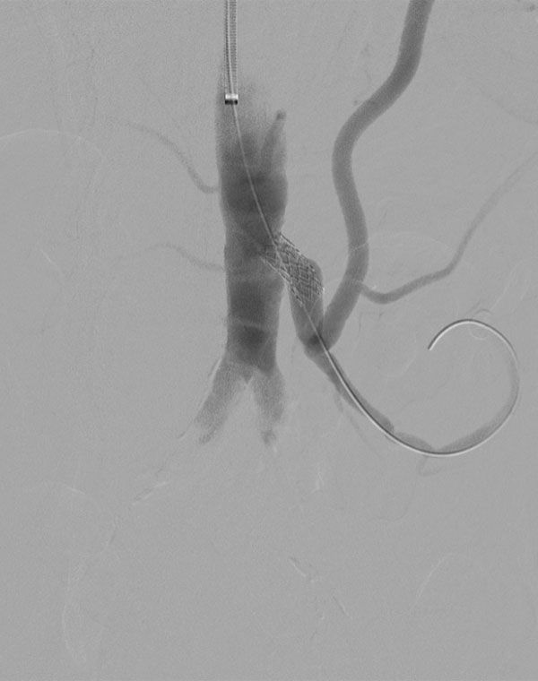 HIGH IMA 2: Inferior mesenteric artery stent